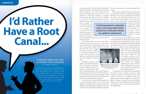 root canal article