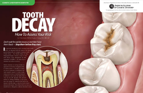 tooth decay how to assess your risk