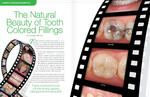 the natural beauty of tooth colored fillings